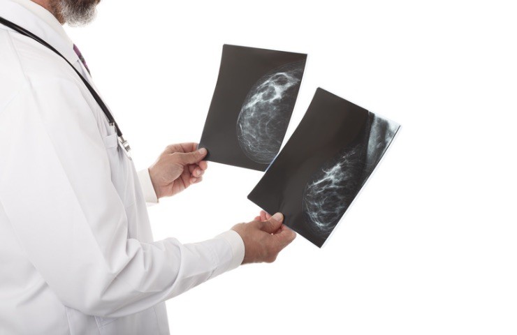 Mammografia: a che età interromperla