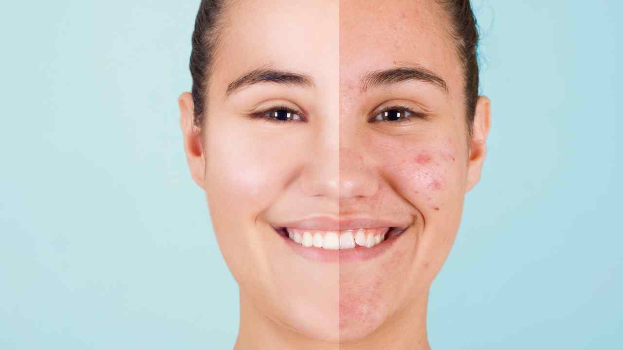 Acne e punti rossi sul viso: i 2 prodotti che li eliminano seduta stante